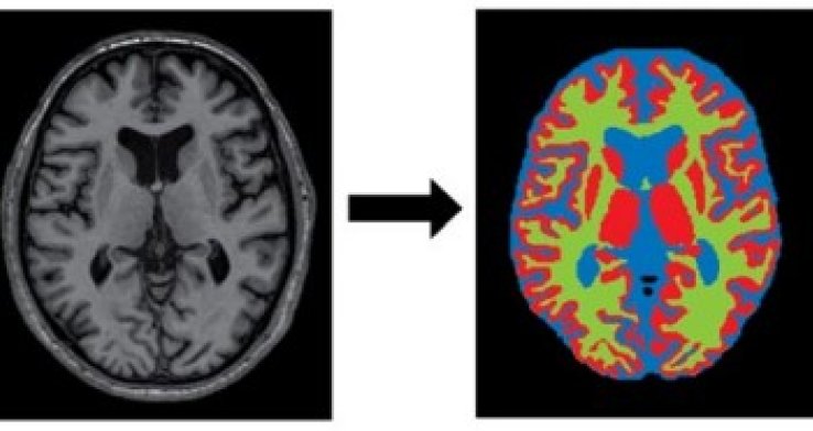 Medische Beeldbewerking met behulp van Artificial Intelligence